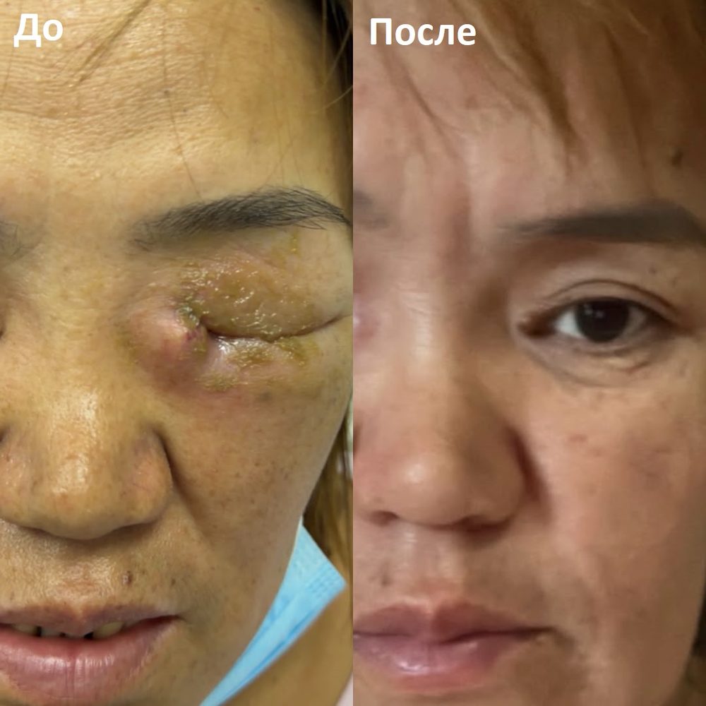 Пациентка, веко: до и после